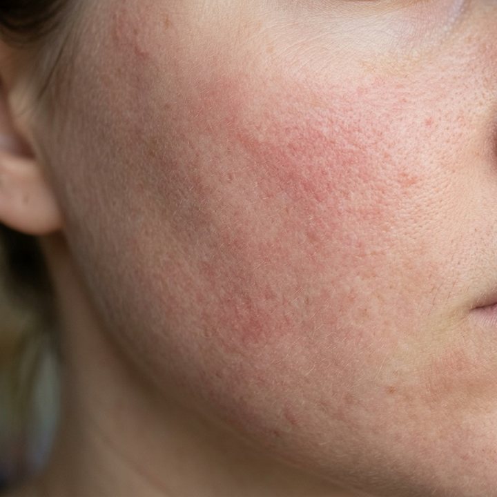Close-up of reddened skin